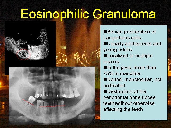 Eosinophilic Granuloma n. Benign proliferation of Langerhans cells. n. Usually adolescents and young adults.