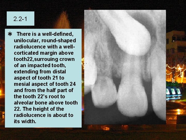 2. 2 -1 ＊ There is a well-defined, unilocular, round-shaped radiolucence with a wellcorticated