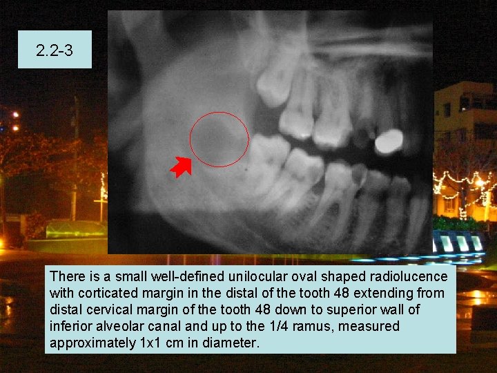 2. 2 -3 There is a small well-defined unilocular oval shaped radiolucence with corticated