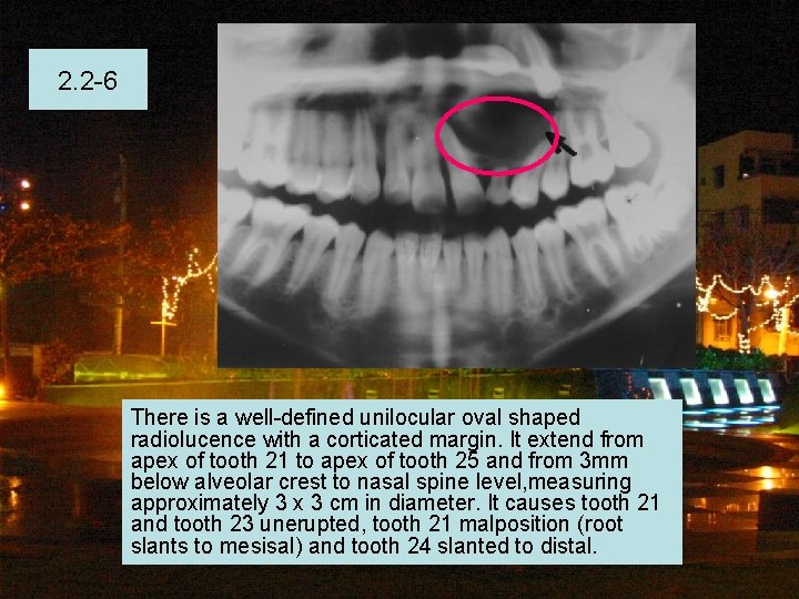 2. 2 -6 There is a well-defined unilocular oval shaped radiolucence with a corticated