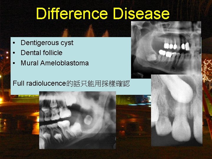 Difference Disease • Dentigerous cyst • Dental follicle • Mural Ameloblastoma Full radiolucence的話只能用採樣確認 