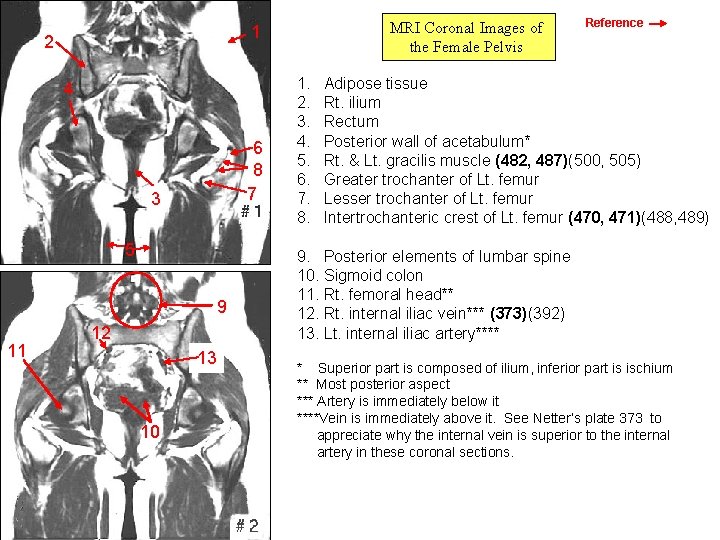 2 4 6 8 7 3 5 9 11 MRI Coronal Images of the