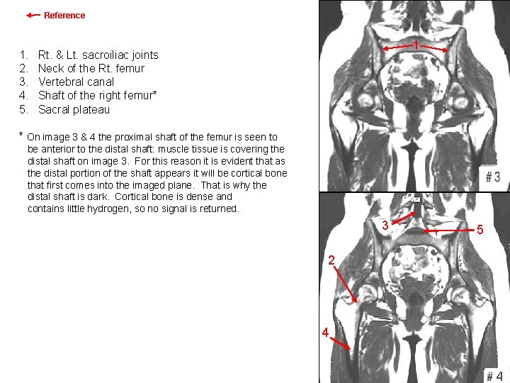 Reference 1. 2. 3. 4. 5. Rt. & Lt. sacroiliac joints Neck of the