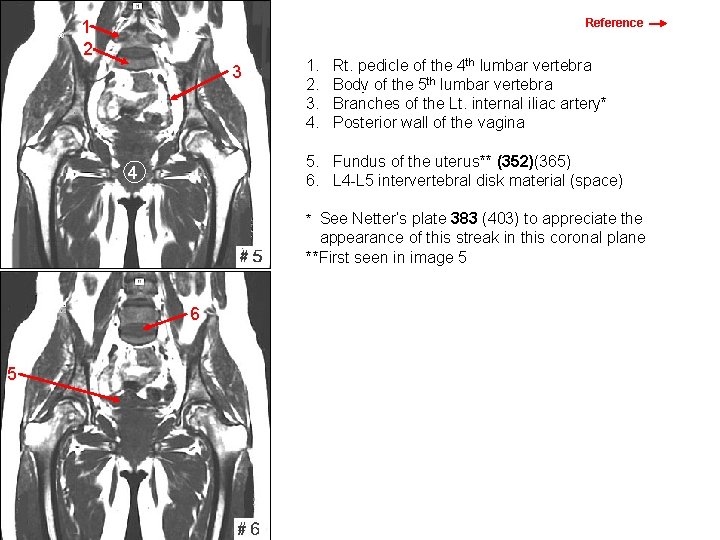 Reference 1 2 3 1. 2. 3. 4. Rt. pedicle of the 4 th