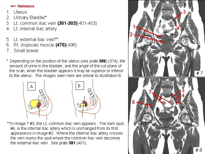 Reference 1. 2. 3. 4. Uterus Urinary Bladder* Lt. common iliac vein (381 -383)(401