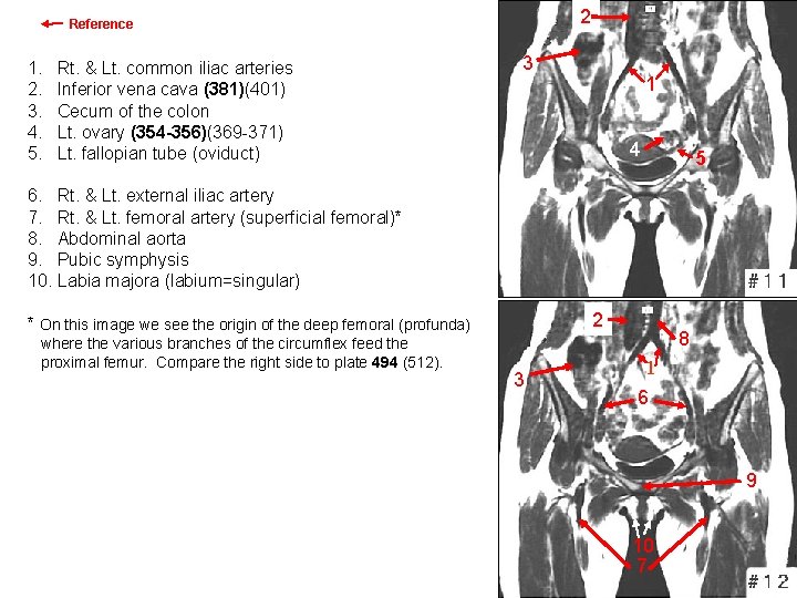 2 Reference 1. 2. 3. 4. 5. Rt. & Lt. common iliac arteries Inferior