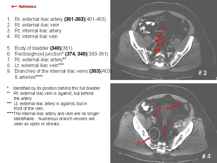Reference Images 3 & 4 1. 2. 3. 4. Rt. external iliac artery (381