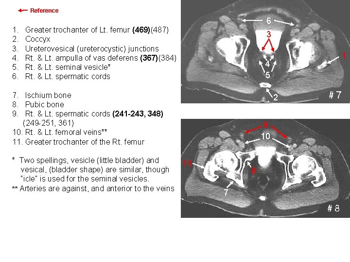 Reference 6 1. 2. 3. 4. 5. 6. Greater trochanter of Lt. femur (469)(487)