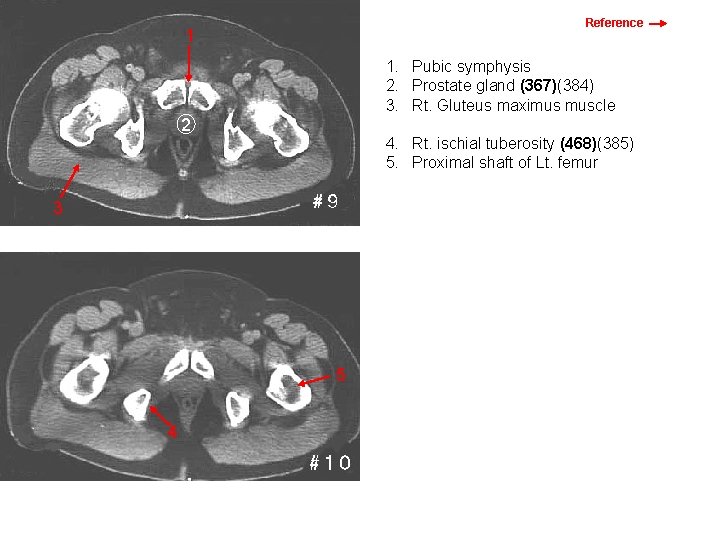 Reference 1 1. Pubic symphysis 2. Prostate gland (367)(384) 3. Rt. Gluteus maximus muscle