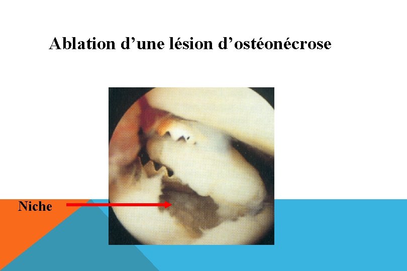 Ablation d’une lésion d’ostéonécrose Niche 