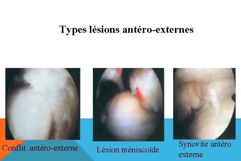 Types lésions antéro-externes Conflit antéro-externe Lésion méniscoïde Synovite antéro externe 