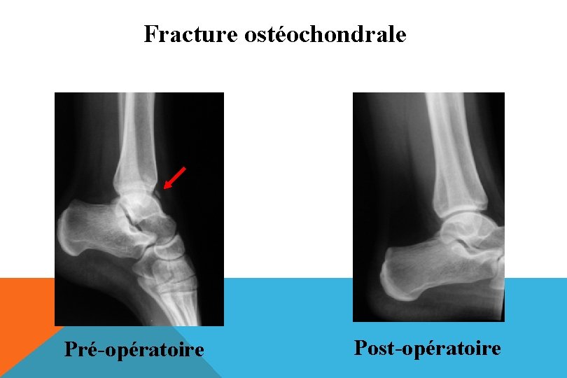 Fracture ostéochondrale Pré-opératoire Post-opératoire 