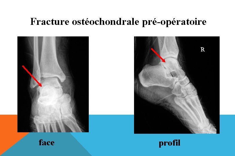 Fracture ostéochondrale pré-opératoire face profil 