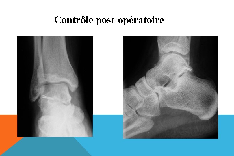 Contrôle post-opératoire 