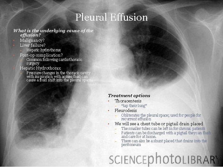 Pleural Effusion What is the underlying cause of the effusion? • Malignancy? • Liver Pleural Effusion What is the underlying cause of the effusion? • Malignancy? • Liver