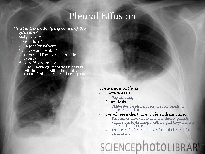 Pleural Effusion What is the underlying cause of the effusion? • Malignancy? • Liver