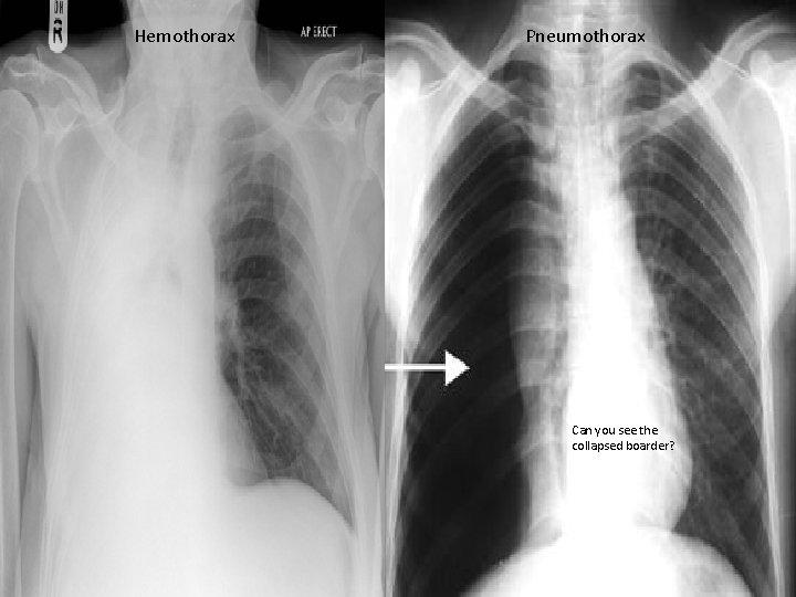 Hemothorax Pneumothorax Can you see the collapsed boarder? 