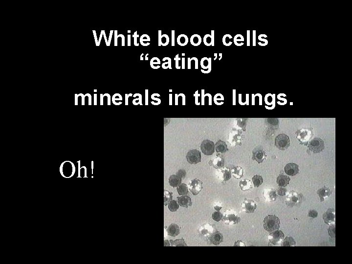White blood cells “eating” minerals in the lungs. Oh! 