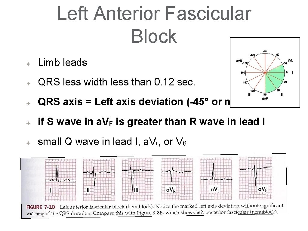 Left Anterior Fascicular Block ✦ Limb leads ✦ QRS less width less than 0.