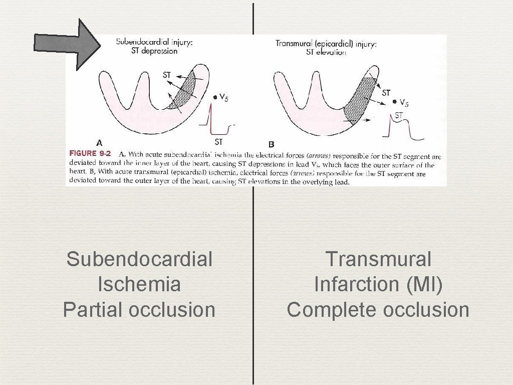 Subendocardial Ischemia Partial occlusion Transmural Infarction (MI) Complete occlusion 