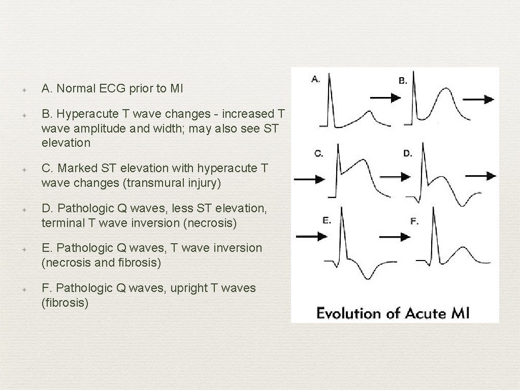 ✦ ✦ ✦ A. Normal ECG prior to MI B. Hyperacute T wave changes