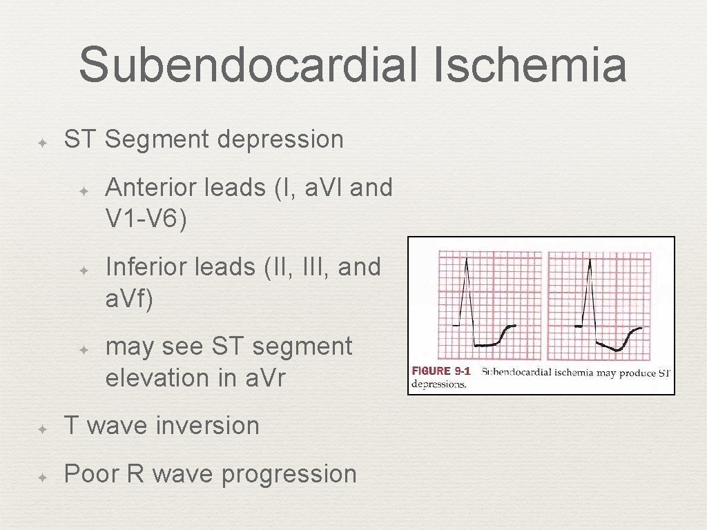 Subendocardial Ischemia ✦ ST Segment depression ✦ ✦ ✦ Anterior leads (I, a. Vl