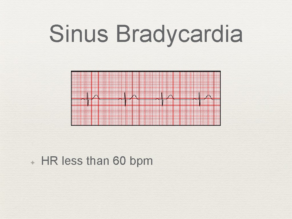 Sinus Bradycardia ✦ HR less than 60 bpm 