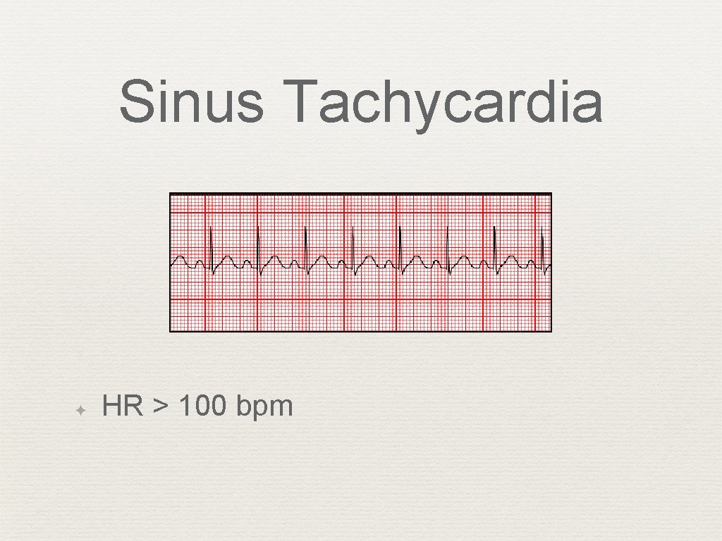 Sinus Tachycardia ✦ HR > 100 bpm 