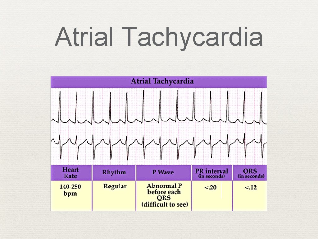 Atrial Tachycardia 