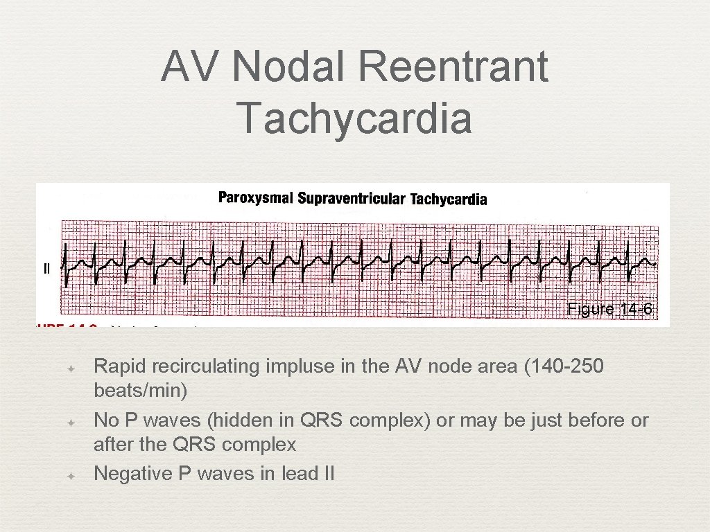 AV Nodal Reentrant Tachycardia Figure 14 -6 ✦ ✦ ✦ Rapid recirculating impluse in