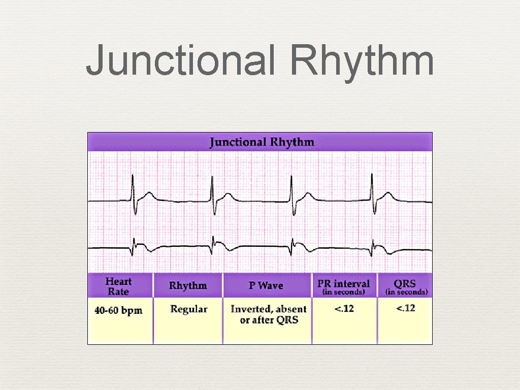 Junctional Rhythm 