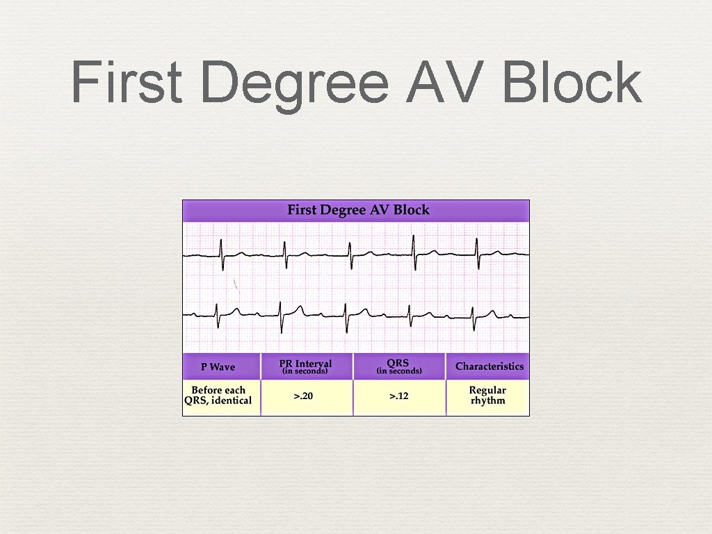 First Degree AV Block 