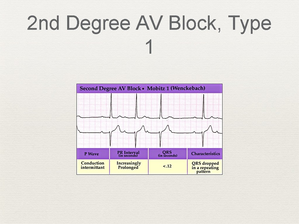 2 nd Degree AV Block, Type 1 