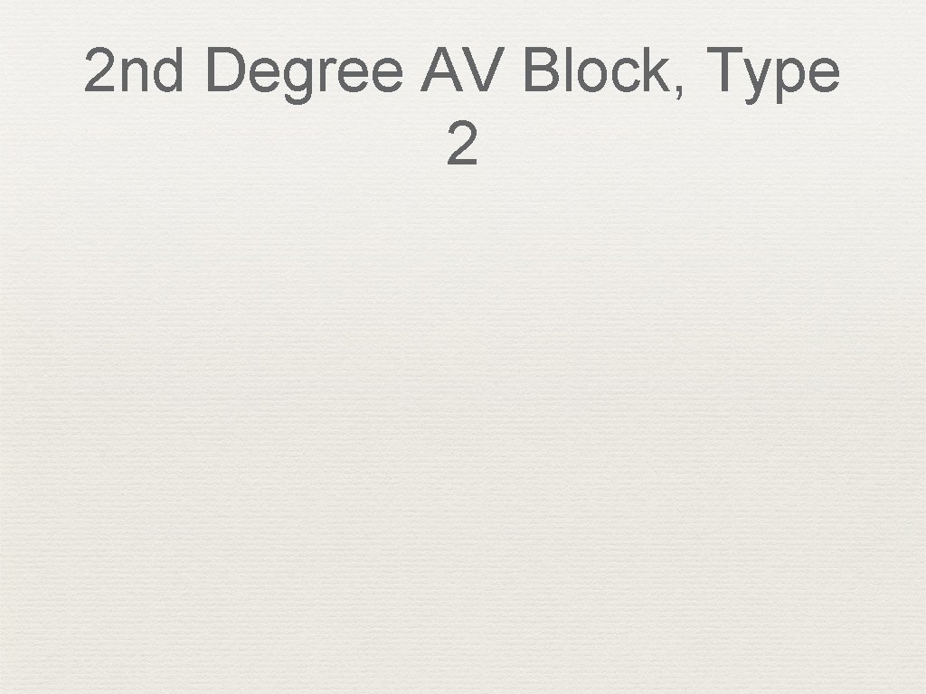 2 nd Degree AV Block, Type 2 