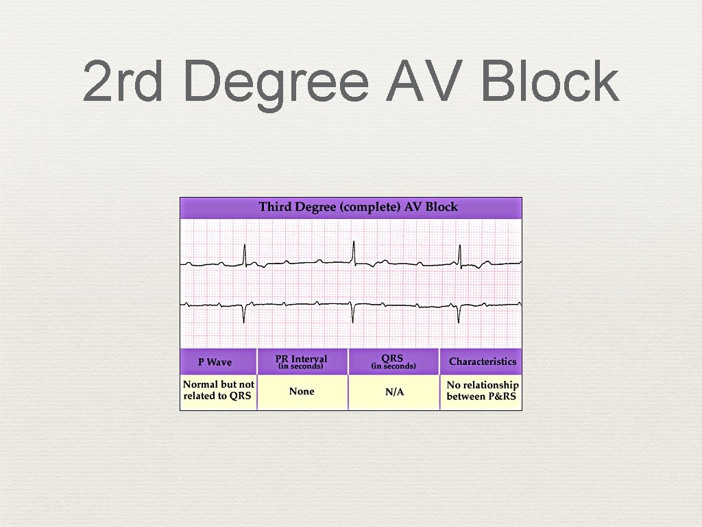 2 rd Degree AV Block 