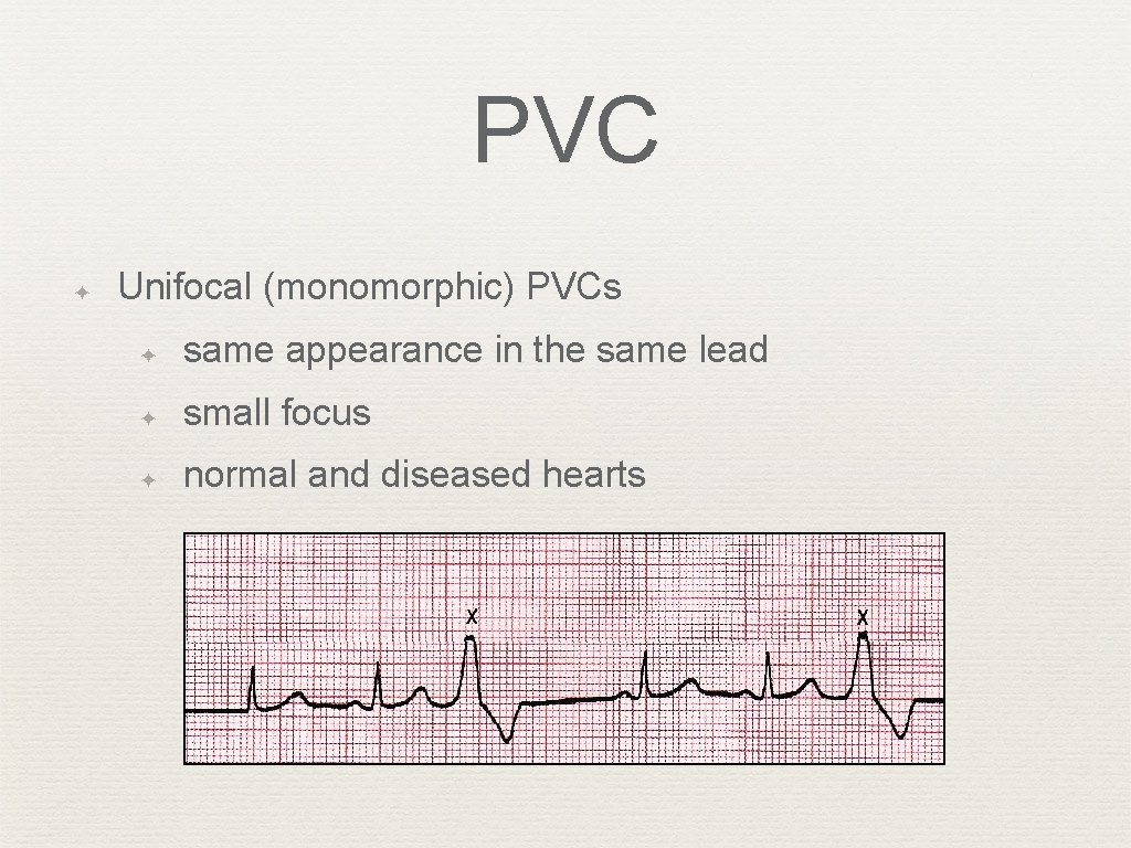 PVC ✦ Unifocal (monomorphic) PVCs ✦ same appearance in the same lead ✦ small