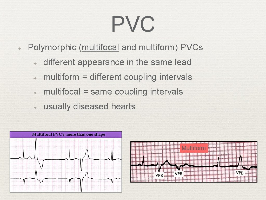 PVC ✦ Polymorphic (multifocal and multiform) PVCs ✦ different appearance in the same lead