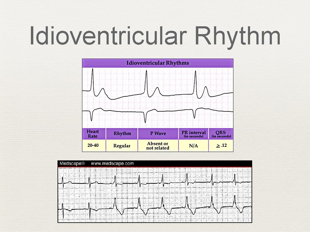 Idioventricular Rhythm 