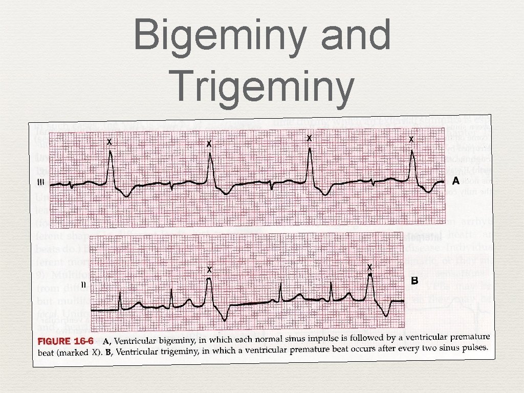 Bigeminy and Trigeminy 