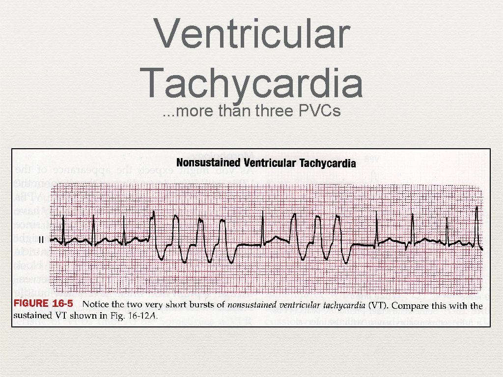 Ventricular Tachycardia. . . more than three PVCs 