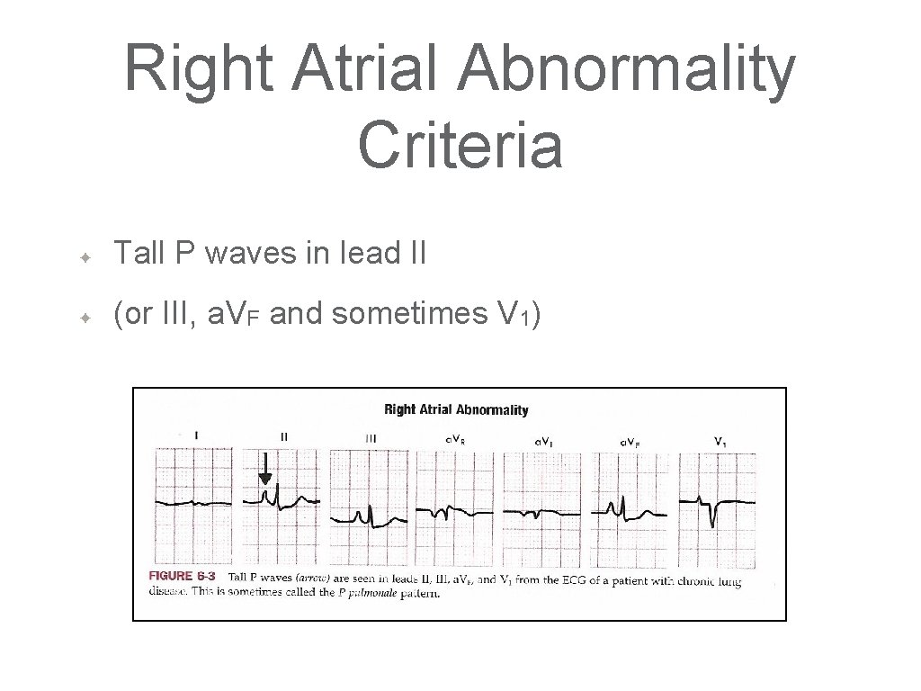 Right Atrial Abnormality Criteria ✦ Tall P waves in lead II ✦ (or III,