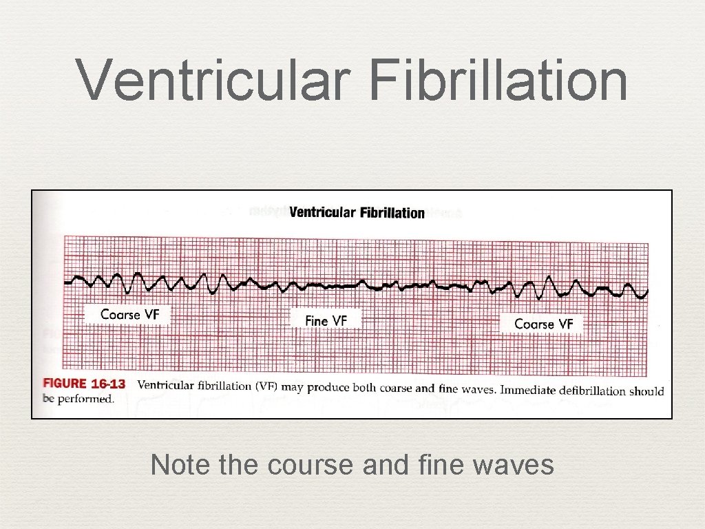 Ventricular Fibrillation Note the course and fine waves 