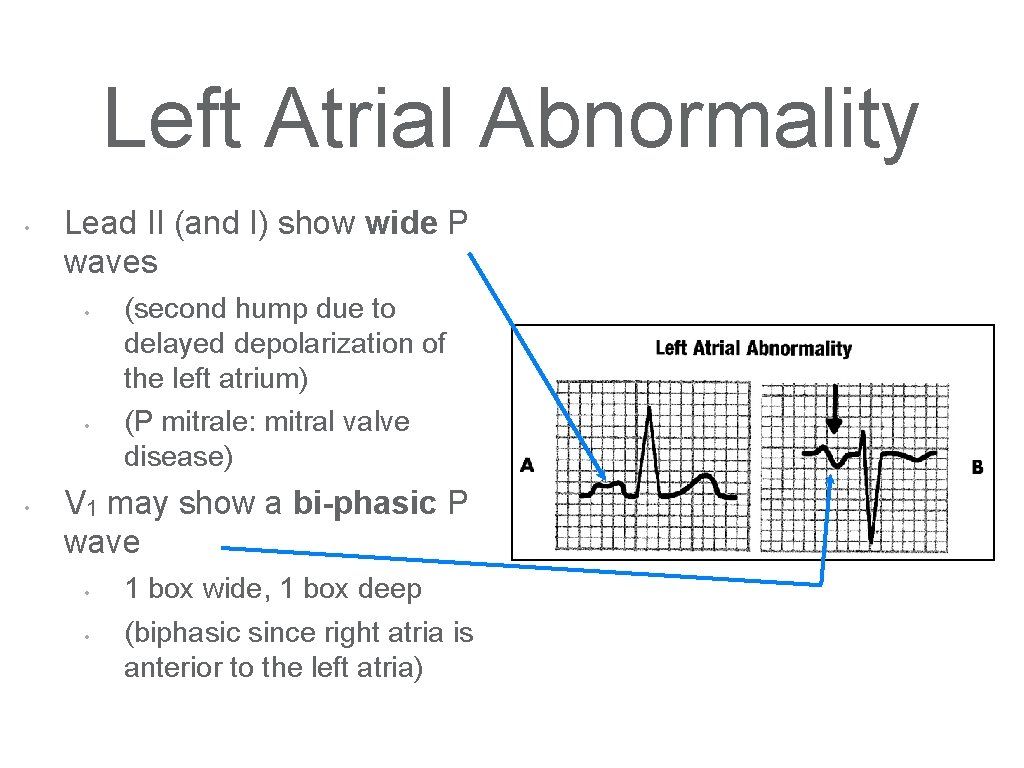 Left Atrial Abnormality • Lead II (and I) show wide P waves • •