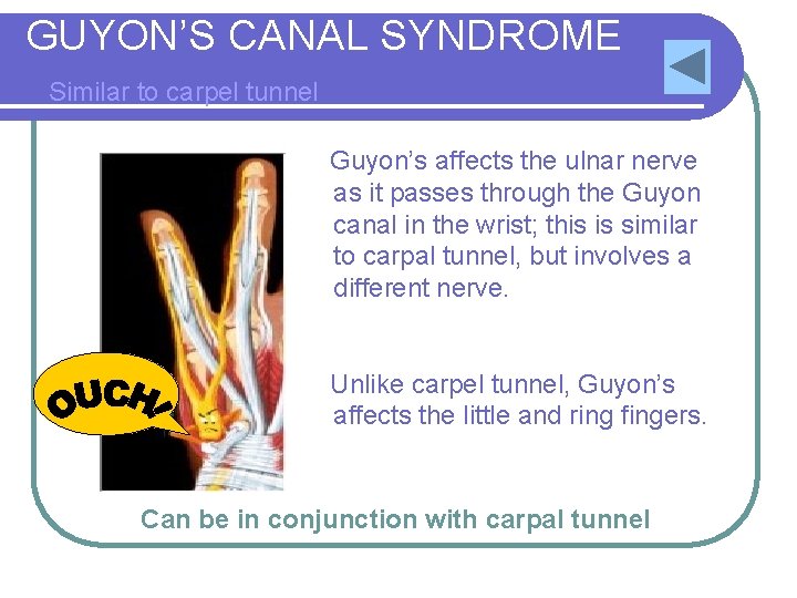 GUYON’S CANAL SYNDROME Similar to carpel tunnel Guyon’s affects the ulnar nerve as it