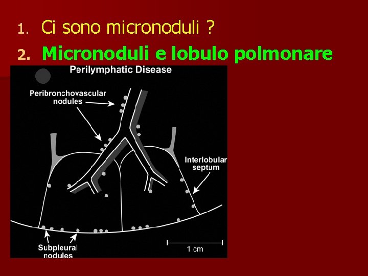 Ci sono micronoduli ? 2. Micronoduli e lobulo polmonare 1. 