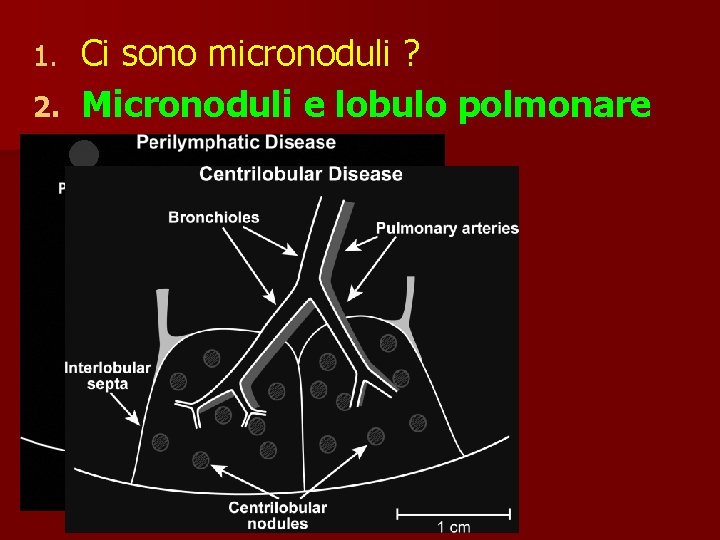 Ci sono micronoduli ? 2. Micronoduli e lobulo polmonare 1. 
