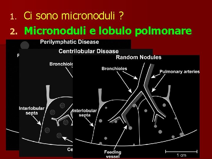 Ci sono micronoduli ? 2. Micronoduli e lobulo polmonare 1. 