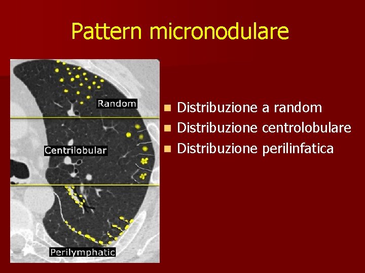 Pattern micronodulare Distribuzione a random n Distribuzione centrolobulare n Distribuzione perilinfatica n 