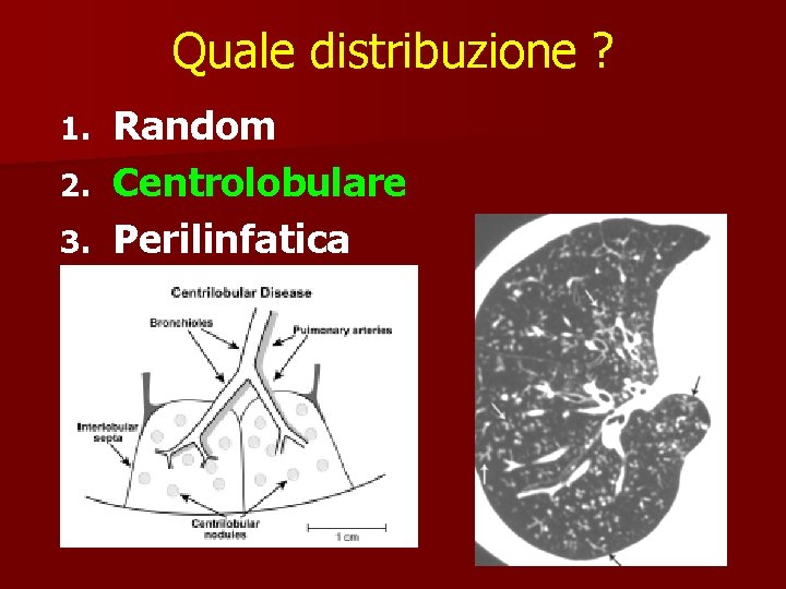 Quale distribuzione ? 1. 2. 3. Random Centrolobulare Perilinfatica 