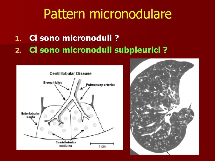 Pattern micronodulare Ci sono micronoduli ? 2. Ci sono micronoduli subpleurici ? 1. 